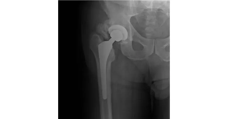 Bone Growth Research